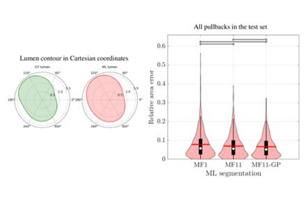 Scientific figure showing two lung diagrams comparing conditions and a violin plot chart of airflow differences across groups.