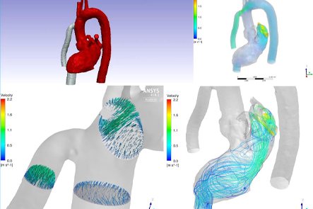 Series of 3D medical visualizations showing blood flow in the aorta and lungs, with color maps and streamlines indicating flow patterns and intensity.